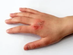 Cegah Luka Bertambah Parah, RSUD Pandega Bagikan Panduan Pertolongan Pertama